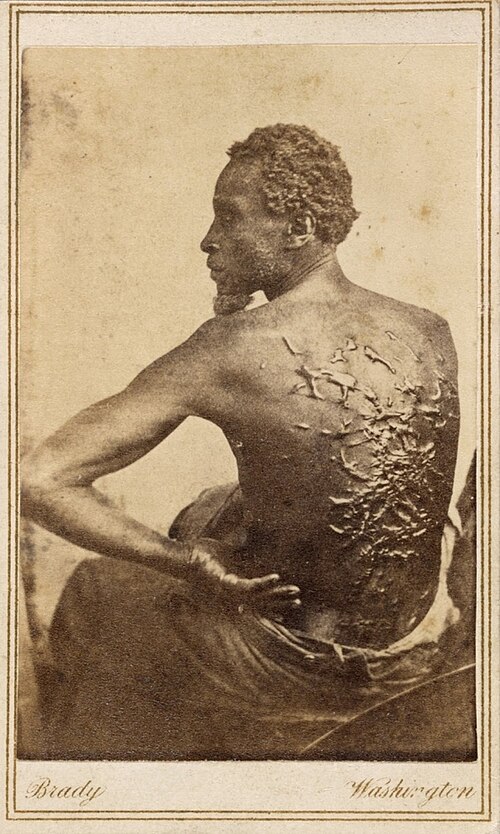 The scarred back of Gordon, an escaped slave, photographed in Baton Rouge, Louisiana, 1863